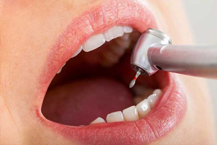 Teeth Cleaning In Dubai Step Two GYA Dental Center