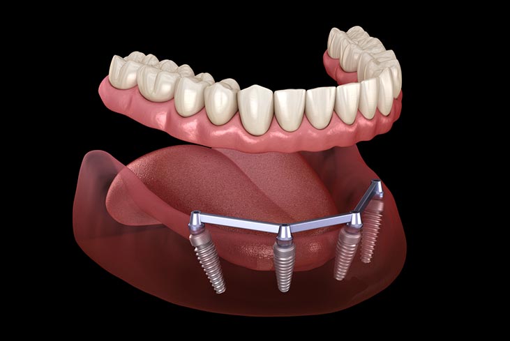 أطقم الأسنان الإصطناعية