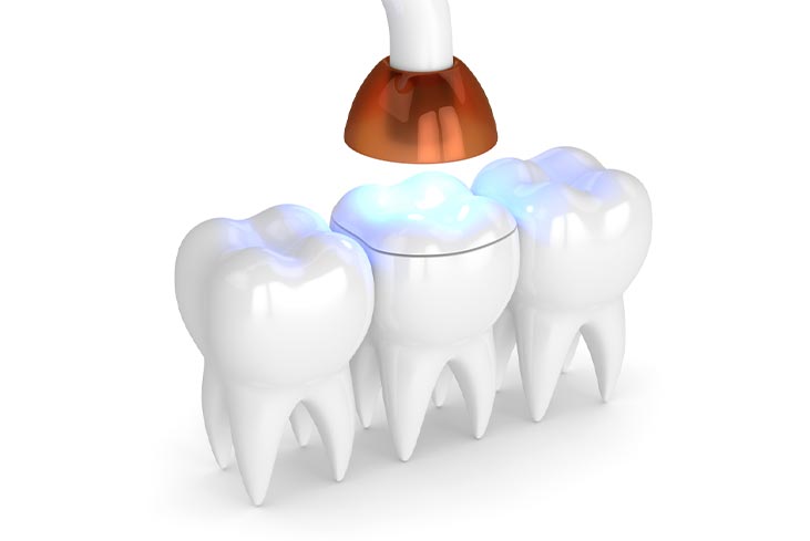 How Dental Inlays and Onlays treatment done?