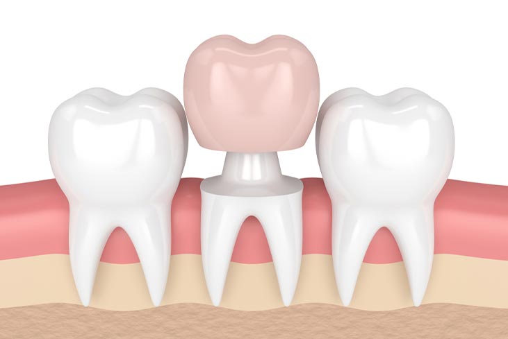 Are onlays/inlays better than fillings or crowns?