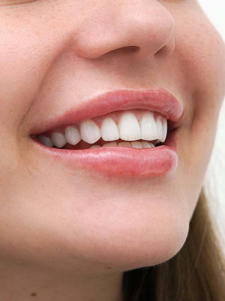 Dental Veneers in Dubai After Close Shot Smile Makeover GYA Dental Center