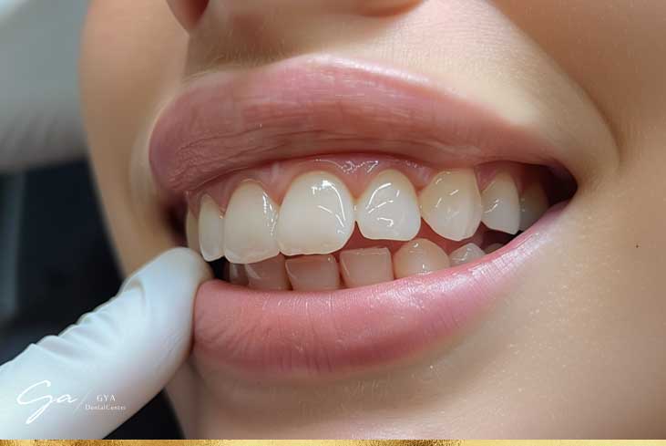 طب الأسنان التجميلي في دبي نحت اللثة