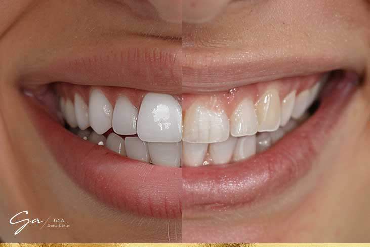 طب الأسنان التجميلي في دبي تجميل الابتسامة الكلي