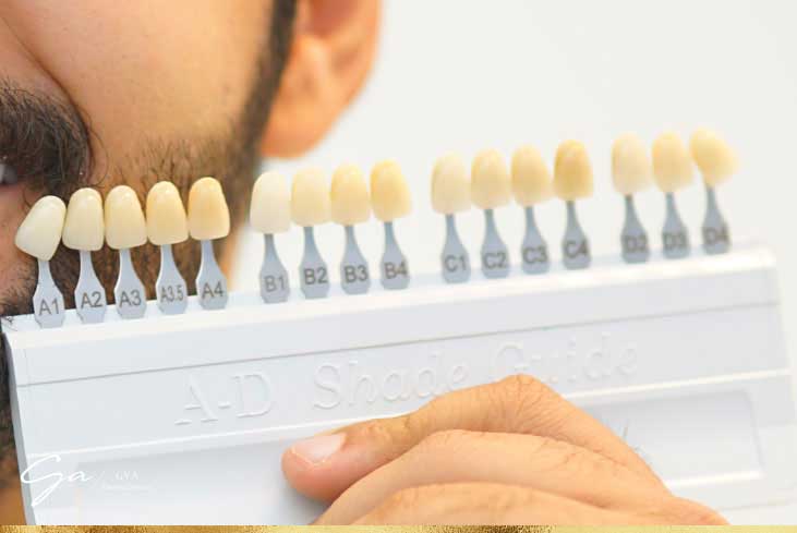 طب الأسنان التجميلي في دبي تبييض الأسنان