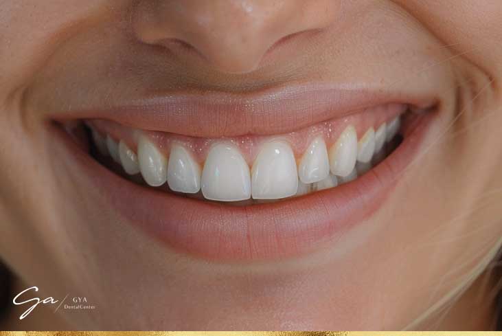 طب الأسنان التجميلي في دبي إزالة البقع البيضاء