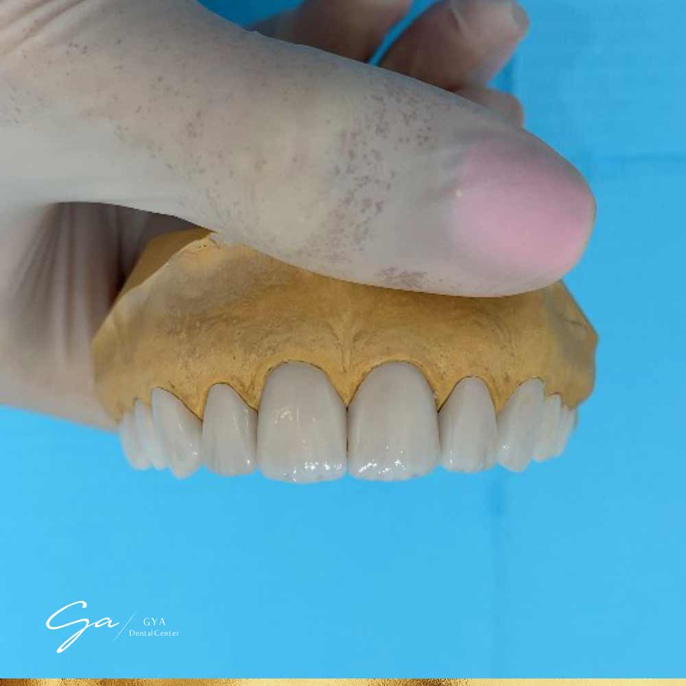 Make a model for the teeth GYA Dental Center