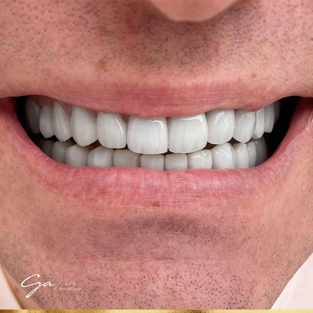 Zirconia Veneers_Best Types Of Dental Veneers In Dubai